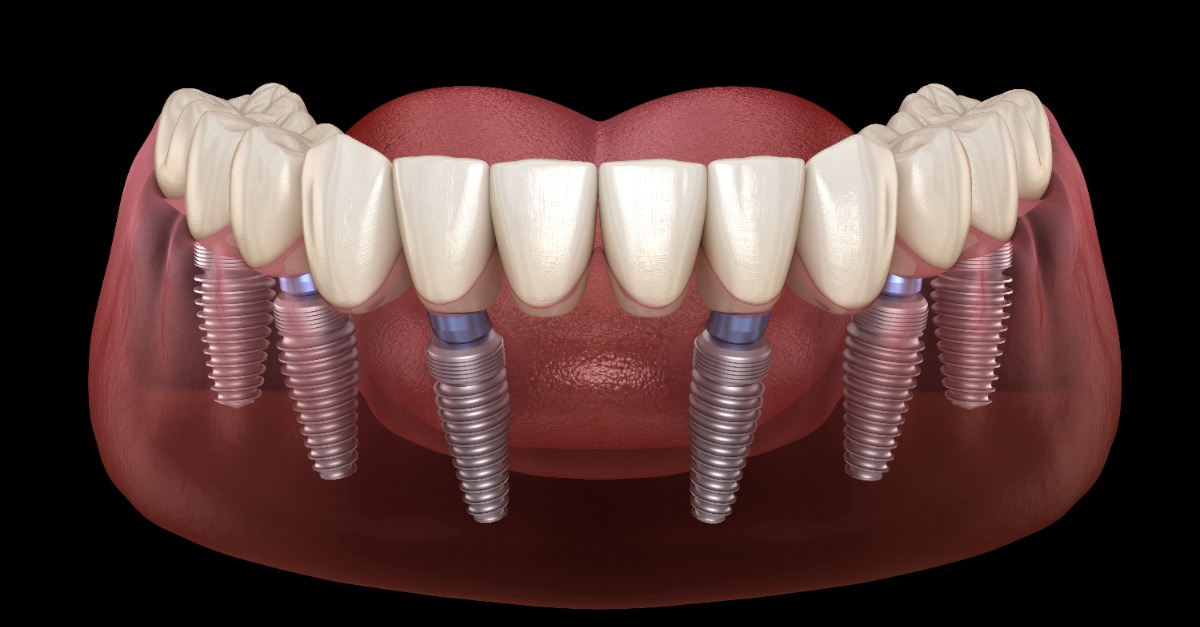 最新消息_全口重建該選擇 All-on-4 (All on 4 )或是 All-on-6  (All on 6 ) 呢?