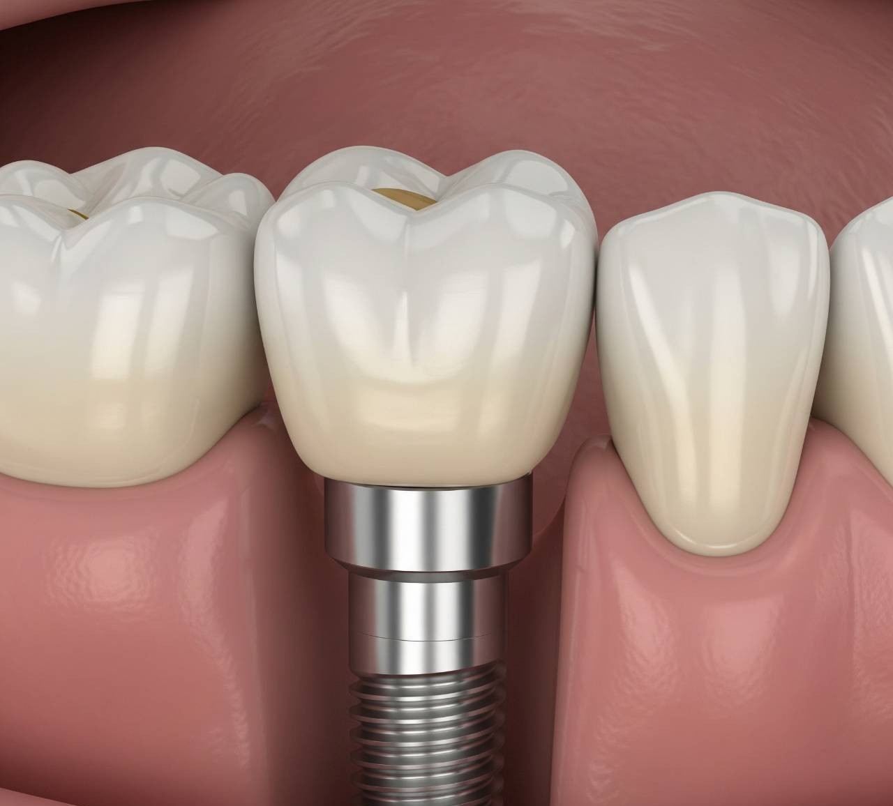 做假牙費用多少？會不會很貴？